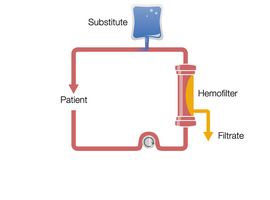 Kontinuierliche veno-venöse Hämofiltration in Postdilution (Post-CVVH)