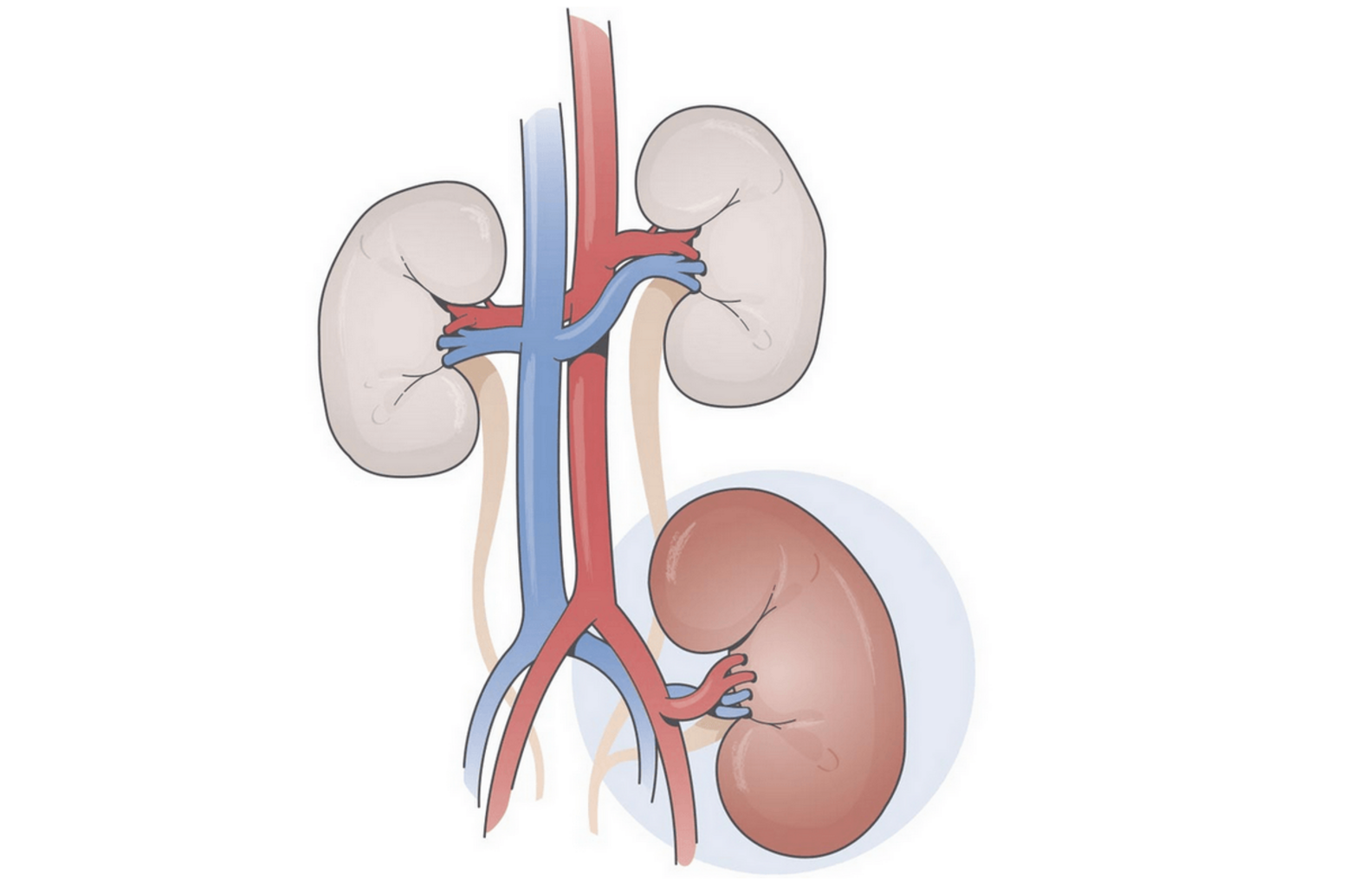 Schematische Darstellung einer transplantierten Niere