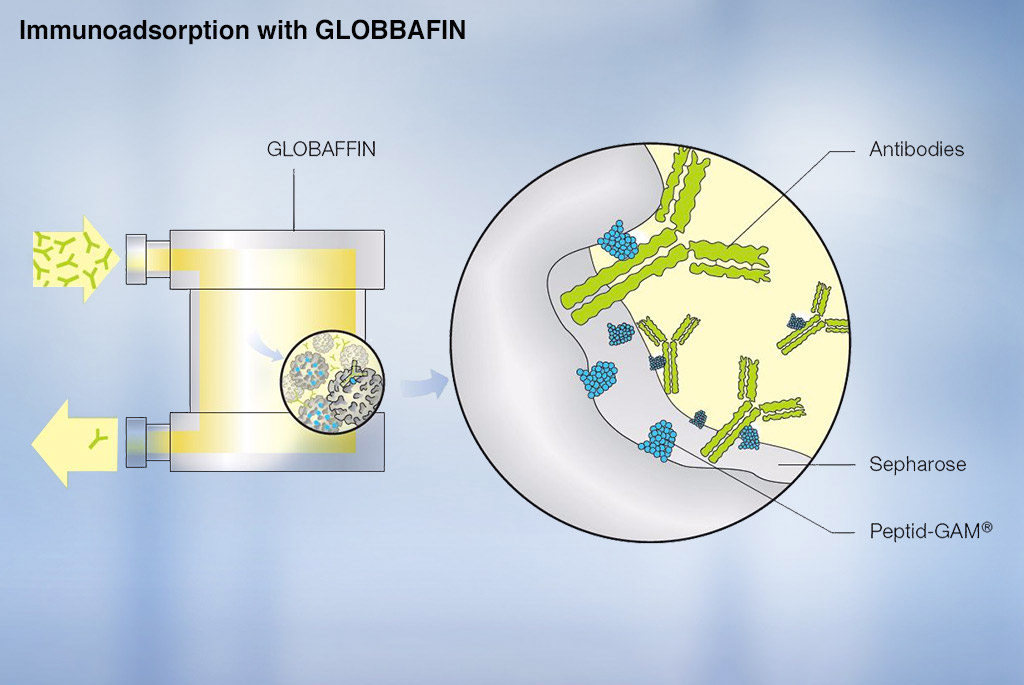 Immunadsorption mit GLOBAFFIN Immunadsorption mit GLOBAFFIN