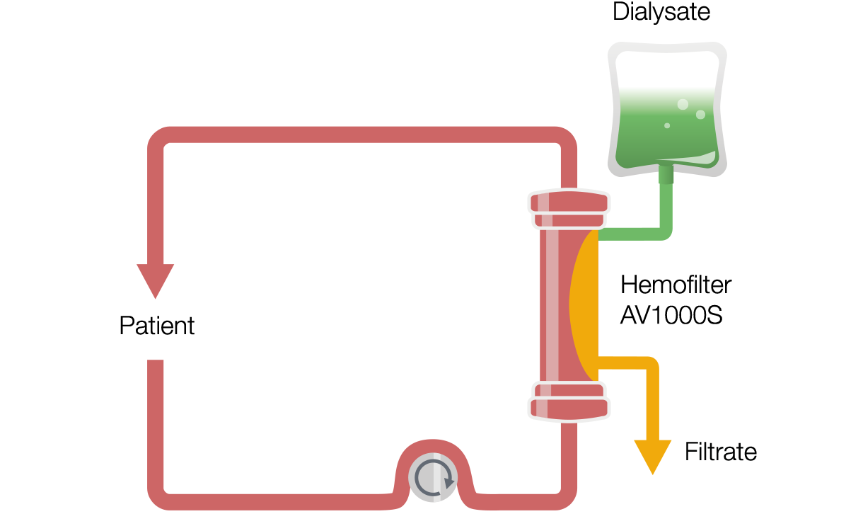 Kontinuierliche veno-venöse Hämodialyse (Continuous Veno-Venous Hemodialysis, CVVHD)